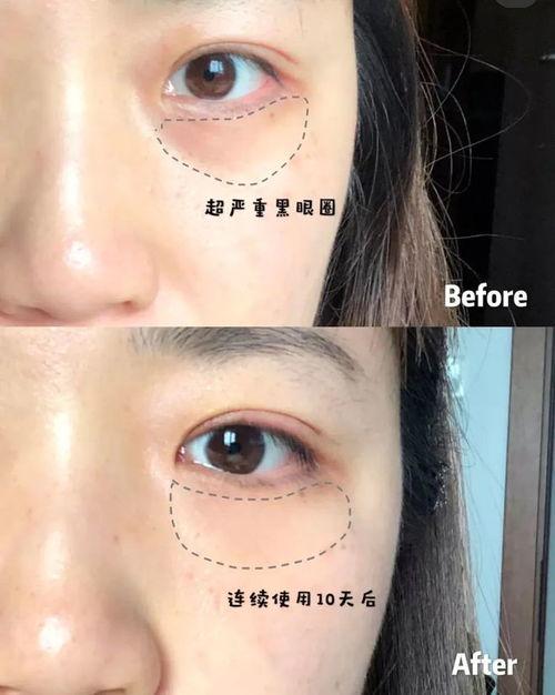 消除眼袋视频,跟随消除眼袋视频教程,重拾明眸光彩