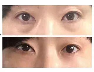 消除眼袋视频,跟随消除眼袋视频教程,重拾明眸光彩