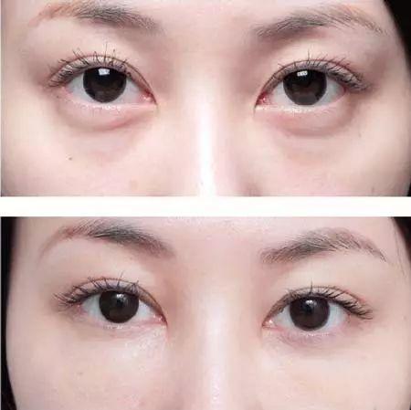消除眼袋视频,跟随消除眼袋视频教程,重拾明眸光彩