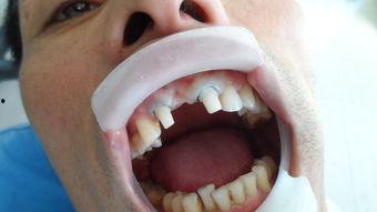 口腔备牙视频,口腔备牙操作步骤解析与技巧展示