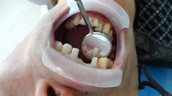 口腔备牙视频,口腔备牙操作步骤解析与技巧展示